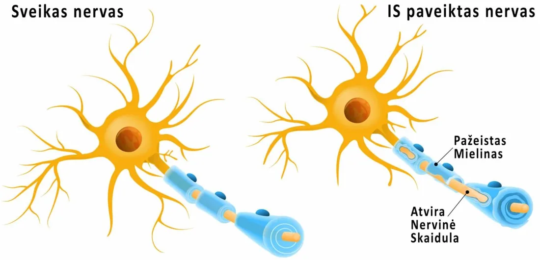 Multiple sclerosis and the nervous system